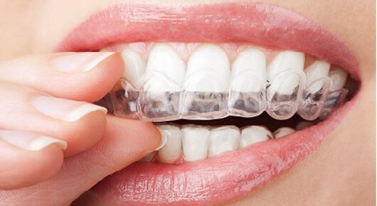 teeth whitening coupon dubai